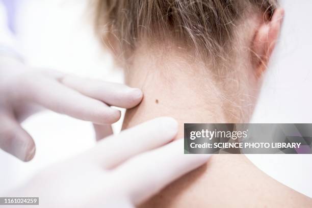doctor examining patient's mole - mélanome photos et images de collection