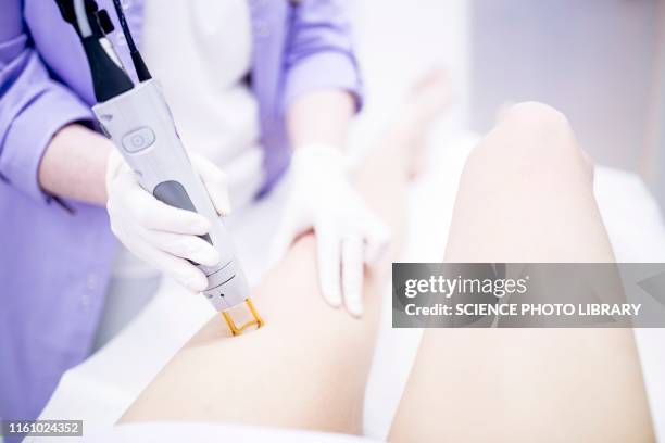 laser hair removal treatment - láser fotografías e imágenes de stock