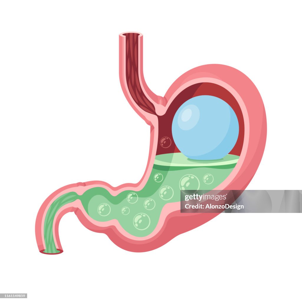 Vetor gástrico do balão. Estômago humano.