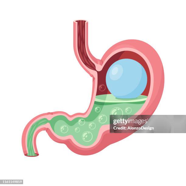 gastric balloon vector. human stomach. - laparoscopic surgery equipment stock illustrations