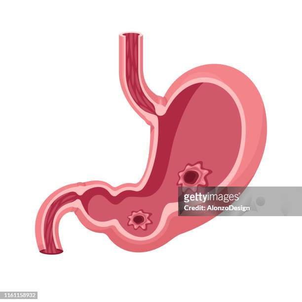 stomach ulcer vector - ulcer stock illustrations