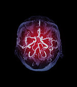 MRA brain axial MIP view showing  Vessel in the brain name is circle of Willis.