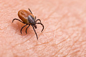 Infected female deer tick on hairy human skin. Ixodes ricinus. Dangerous mite detail. Acarus. Infectious borreliosis