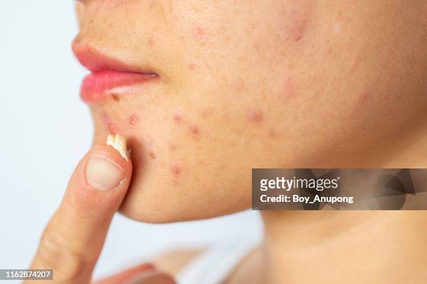 woman applying acne cream on her face for solving acne inflammation (papule and pustule) on her face. - ugly lips stock pictures, royalty-free photos & images