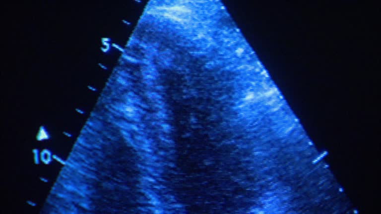 225 Echocardiogram Stock Videos, Footage, & 4K Video Clips - Getty Images