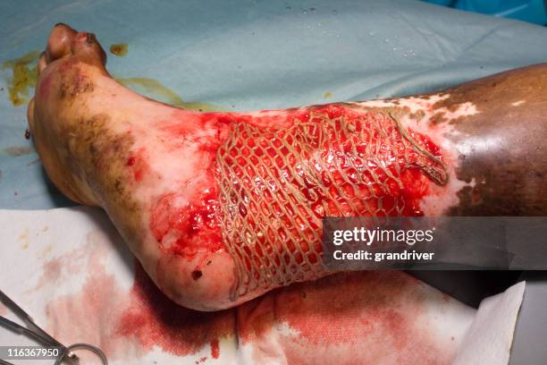 injerto de piel - quemar fotografías e imágenes de stock