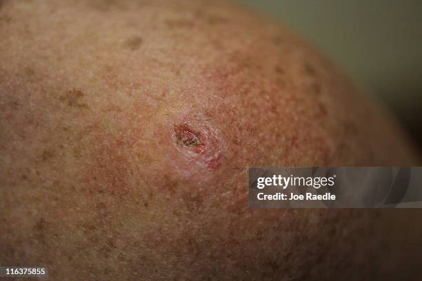 Amy Rey has a mark on her skin after a biopsy was performed on a lesion to check for cancer due to sun exposure on June 15, 2011 in Miami, Florida....