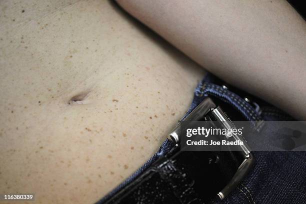 Amy Rey has freckles on her belly, as she gets a skin exam by a dermatologist at the University Of Miami School Of Medicine, she uses sun screen...