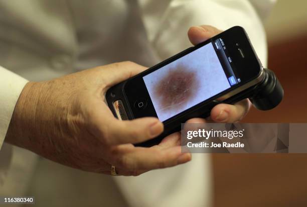 Doctor Antonella Tosti, Dermatologist University of Miami School of Medicine, displays an image on her iphone of a mark on the skin of Michael Casa...