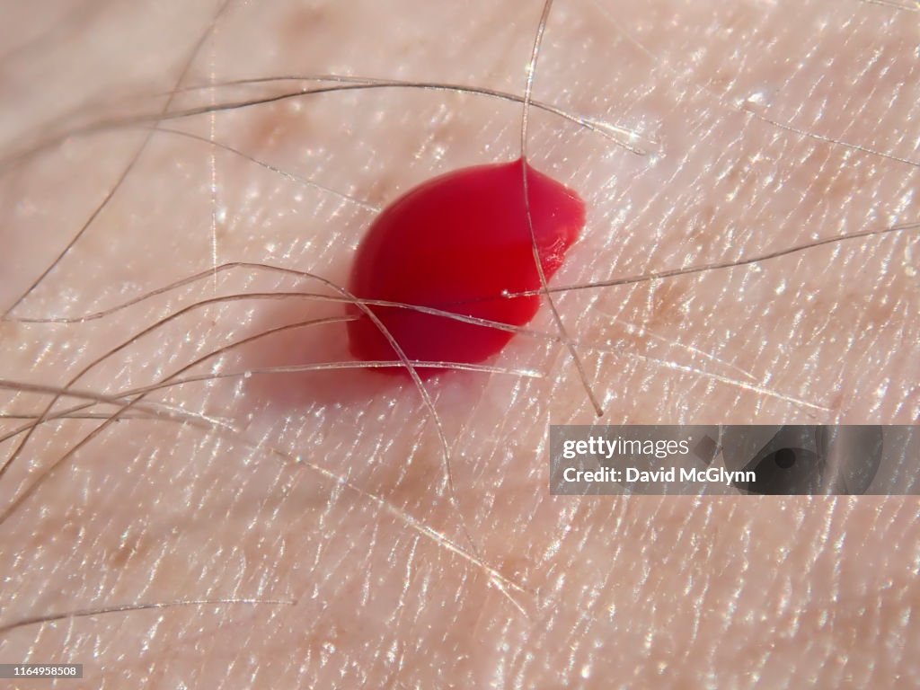 Greenhead fly biting person's skin