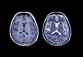 Comparison MRI brain Axial T1 and T2  for detect a variety of conditions of the brain such as cysts, tumors, bleeding, swelling, developmental and structural abnormalities, infections.