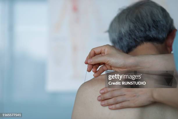 oriental medicine doctor treating acupuncture on shoulder - acupuncture elderly stock pictures, royalty-free photos & images