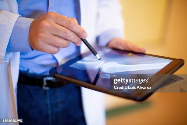doctor reviewing patients leg x-ray - hueso humano fotografías e imágenes de stock
