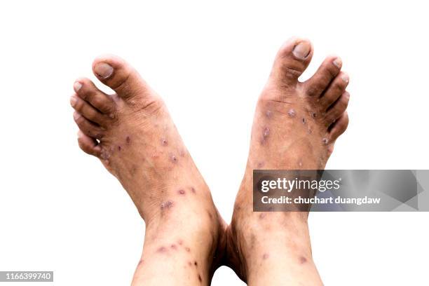 Saudi Foot Rash Foot Rash Photos and Premium High Res Pictures - Getty Images