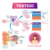 Vertigo vector illustration. Labeled medical vestibular ear problem scheme.