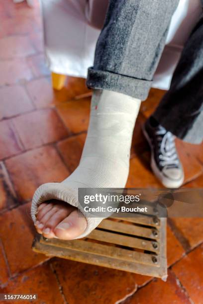 close-up on a woman's feet in the plaster cast on a footrest in the countryside. - gebrochenes bein stock-fotos und bilder