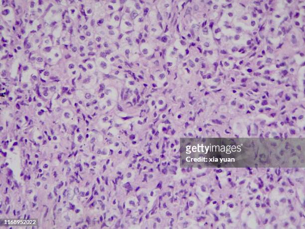 malignant lymphoma,40x light micrograph - stain test stock-fotos und bilder