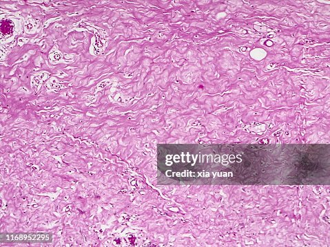 Connective Tissue Hyalinization,10x light micrograph Connective Tissue Hyalinization,10x light micrograph