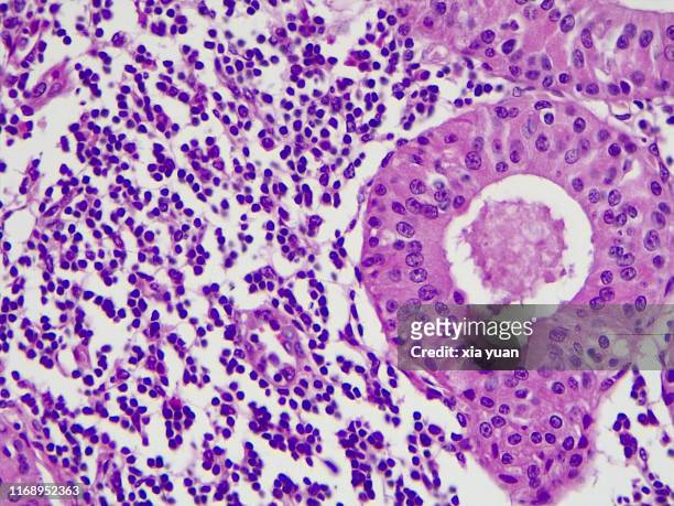 adenolymphoma cancer cell,40x light micrograph - cancer center bildbanksfoton och bilder