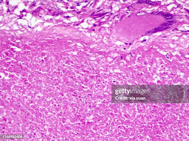 caseous necrosis of lymphatic node,40x light micrograph - lymphoma 個照片及圖片檔