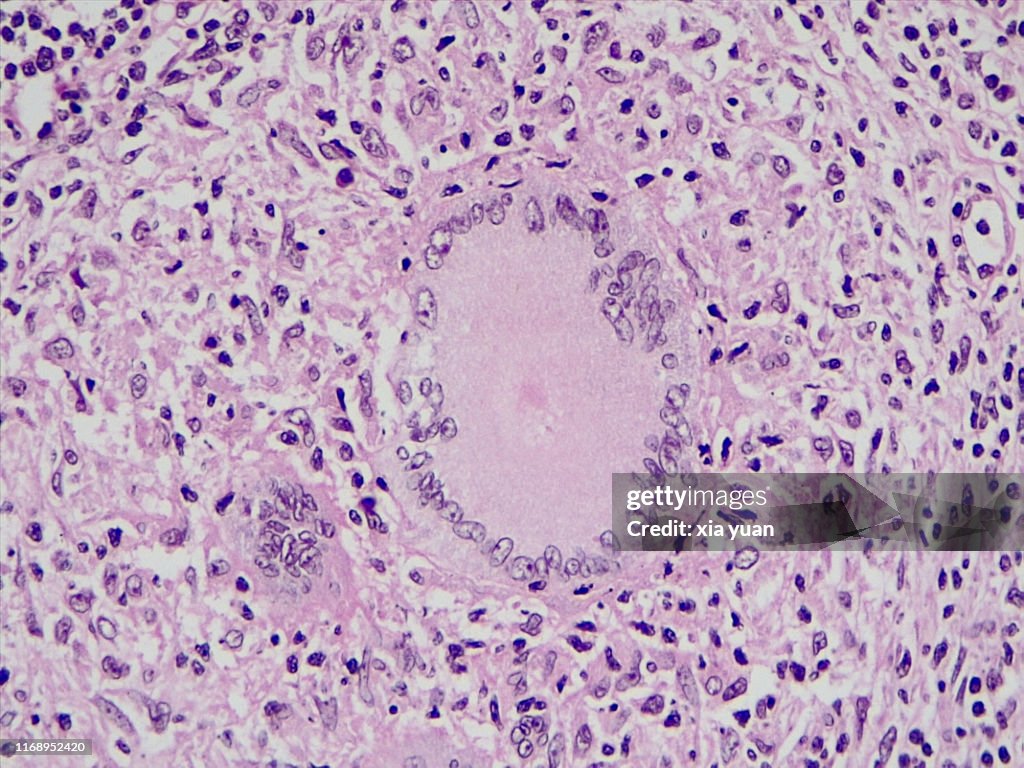 Multinucleated Giant Cells In Tuberculosis Lymph Nodes,40x light micrograph