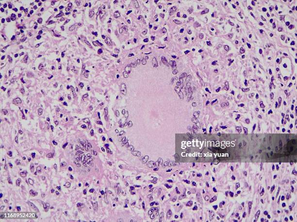 multinucleated giant cells in tuberculosis lymph nodes,40x light micrograph - tuberculosis bacterium 個照片及圖片檔