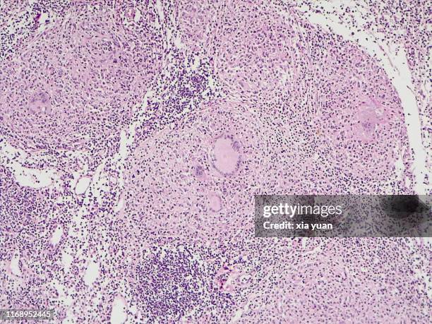 Lymph Node In Microscope 57 Lymph Node Microscope Stock Photos, High-Res Pictures, and Images ...