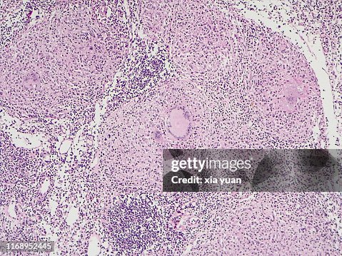 Lymph Node Tuberculosis,10x light micrograph Lymph Node Tuberculosis,10x light micrograph