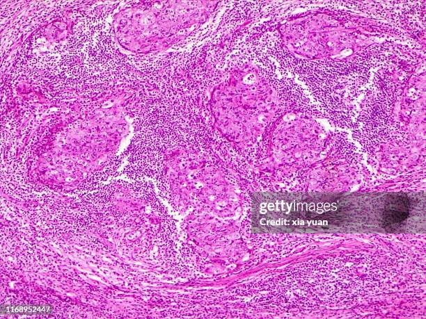 Lymph Node In Microscope 62 Lymph Node Microscope Stock Photos, High-Res Pictures, and Images ...
