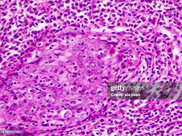 adenocarcinoma of lymph nodes,40x light micrograph - zellmembran stock-fotos und bilder