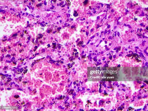 chronic pulmonary congestion,40x light micrograph - stain test stock-fotos und bilder