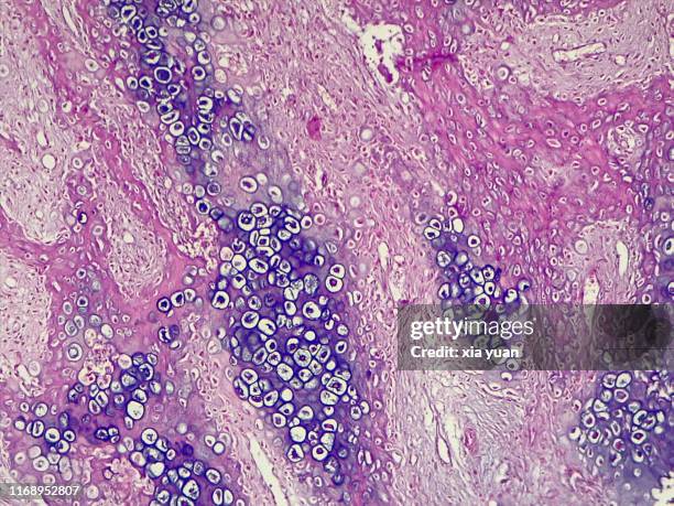 fracture callus,10x light micrograph - ヘマトキシリンエオジン染色 ストックフォトと画像