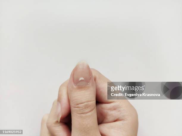 white spots on nail isolated on white background. disease leuconychia - calcita fotografías e imágenes de stock