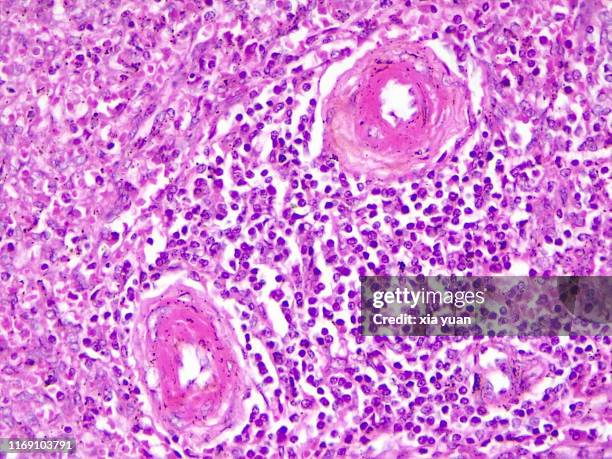 splenic arterioles hyalinization,40x light micrograph - spleen stock pictures, royalty-free photos & images