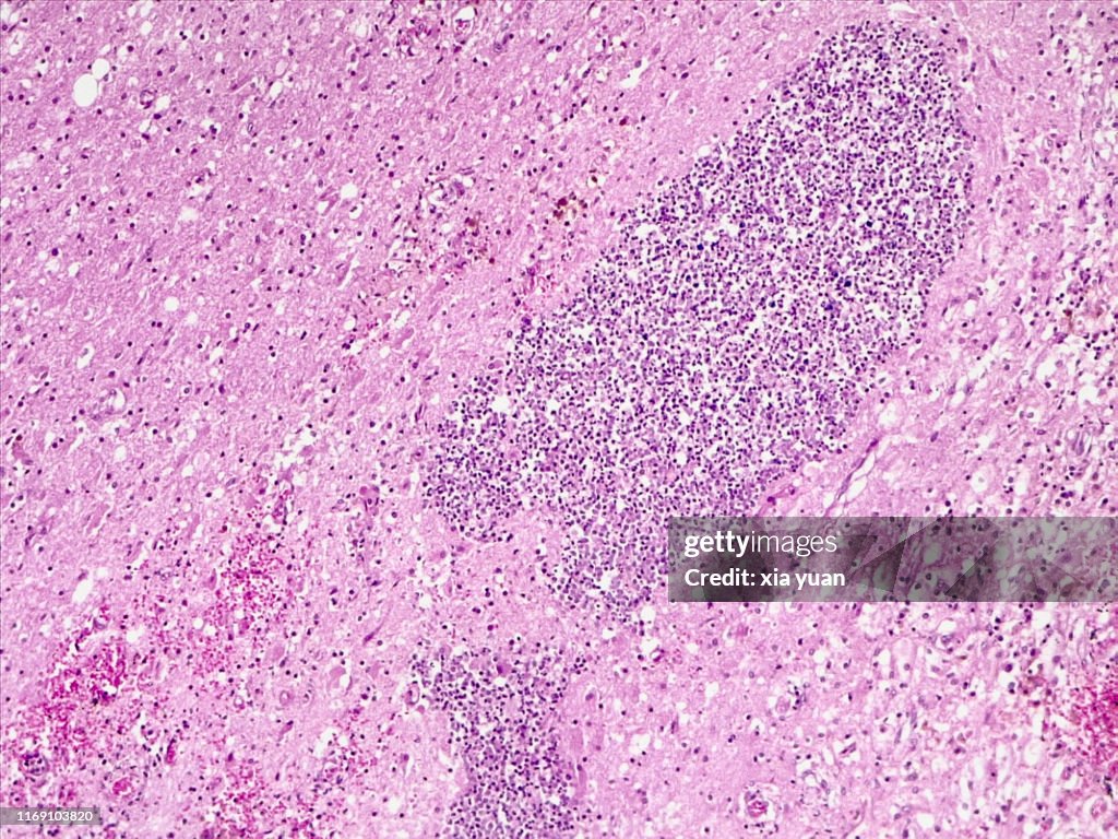 Liquefactive Necrosis Of Human Brain,10x light micrograph