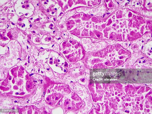hyalinization of renal tubular epithelial cells,40x light micrograph - tejido epitelial fotografías e imágenes de stock
