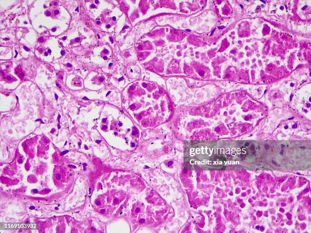 hyalinization of renal tubular epithelial cells,40x light micrograph - inflammation stock pictures, royalty-free photos & images