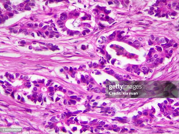 adenocarcinoma,40x light micrograph - stain test stock-fotos und bilder