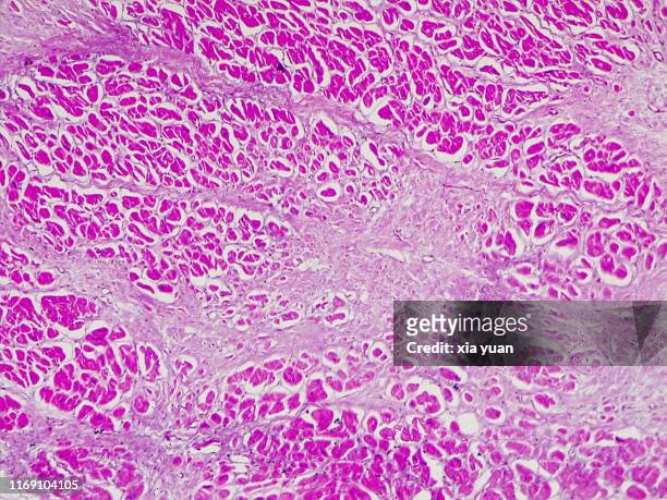 myocardial infarction (heart attack),10x light micrograph - cellulose stockfoto's en -beelden