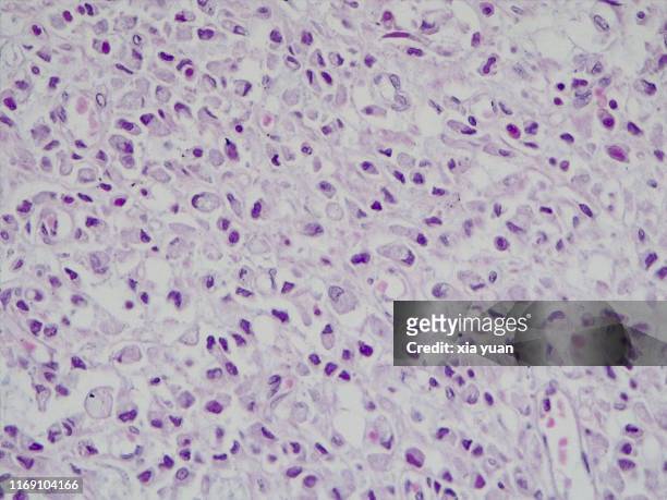signet ring cell carcinoma,40x light micrograph - ヘマトキシリンエオジン染色 ストックフォトと画像