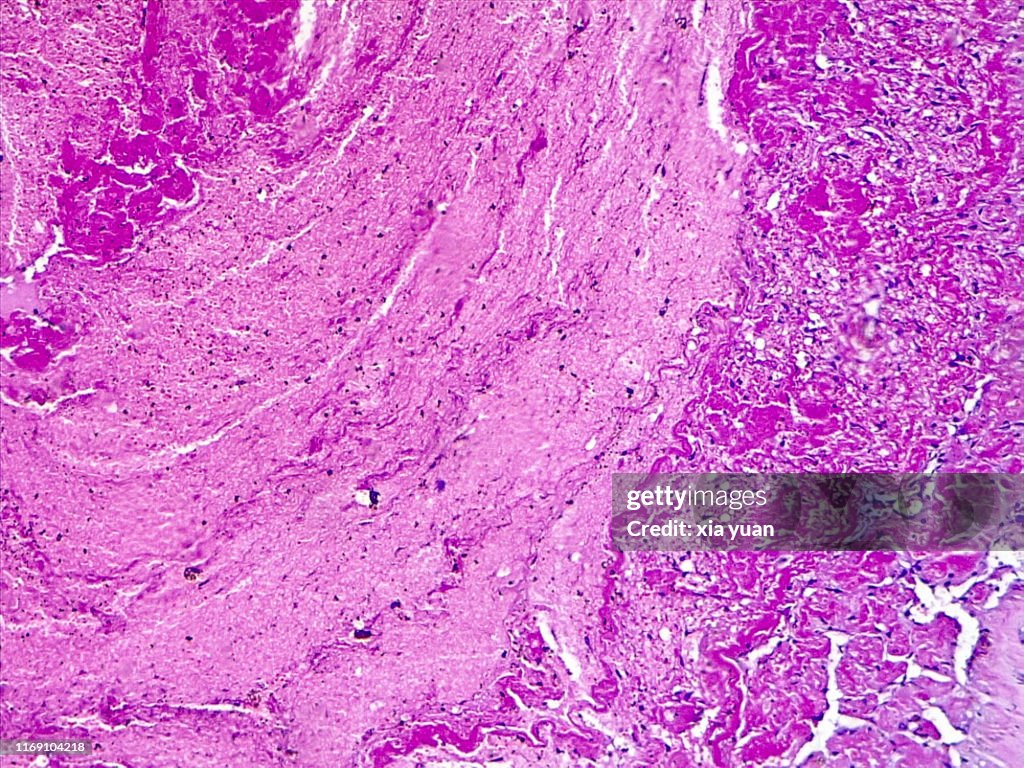 Thrombus Inside Vein,10x light micrograph