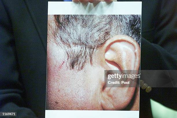 Former NFL Star and Actor O.J. Simpson's attorney Lee Cohn holds a photo showing an alleged injury sustained by Jeffrey Pattinson in a confrontation...