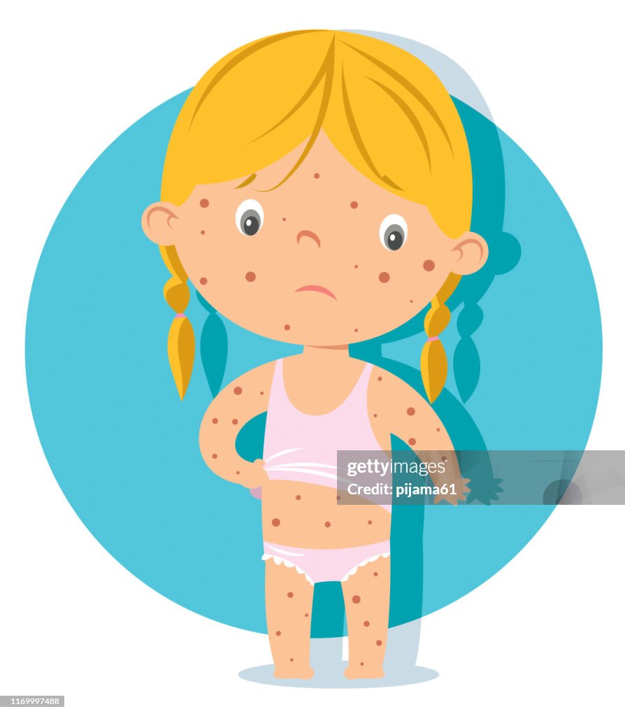 Measles child