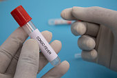 Concept of Laboratory test tube of Crimean Congo hemorrhagic fever or CCHF in hands.