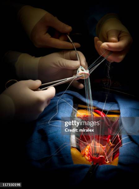 heart surgery aortic valve replacement - hecht stockfoto's en -beelden