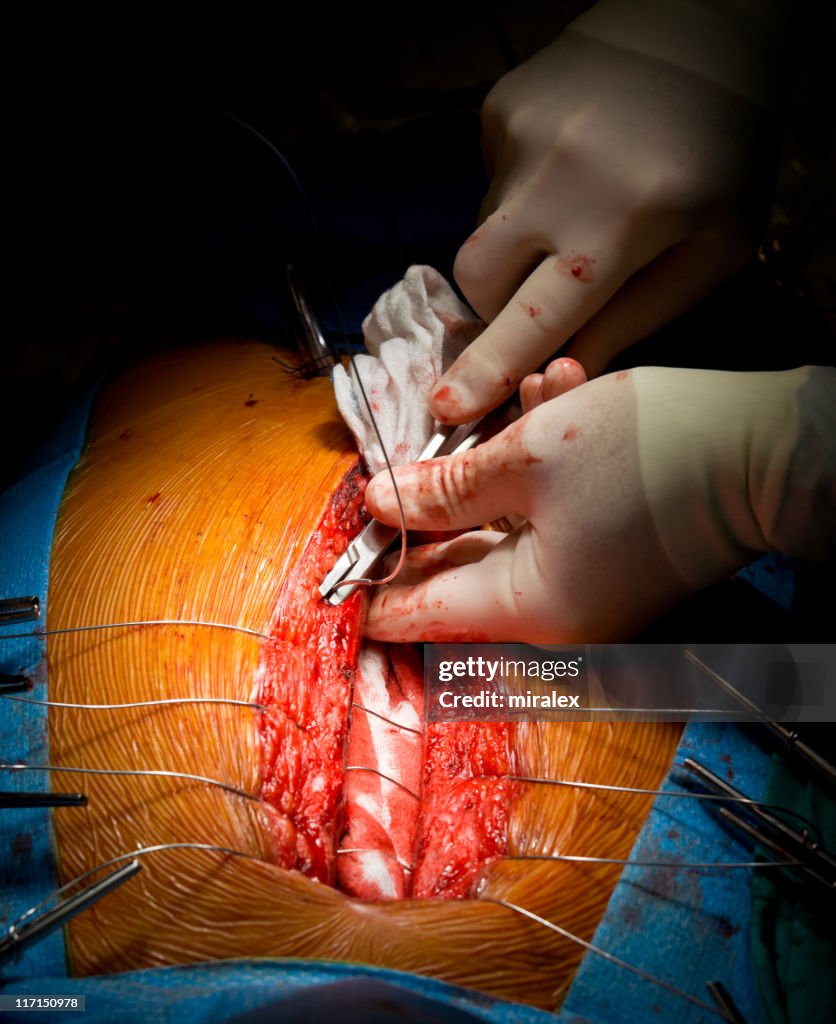 Cirurgia Cardíaca-ESTERNAL encerramento