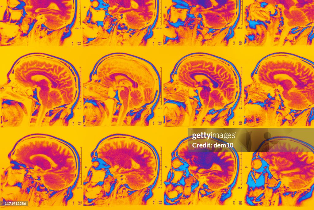 Varredura de MRI do cérebro