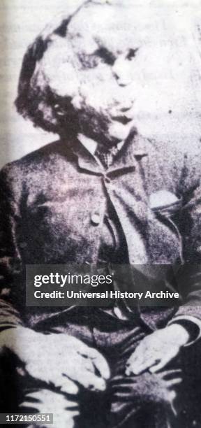 Photograph of Joseph Merrick. Joseph Carey Merrick an English man who suffered with severe deformities. Merrick worked at a freak show as the...