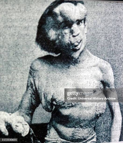 Photograph of Joseph Merrick. Joseph Carey Merrick an English man who suffered with severe deformities. Merrick worked at a freak show as the...