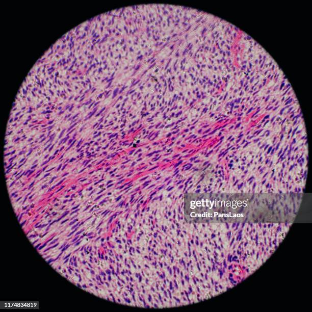 fibrosarcoma human cancer cells under microscope - oncology abstract stock pictures, royalty-free photos & images